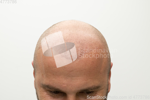 Image of man after hair implant therapy