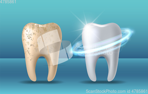 Image of Clean and dirty tooth before and after whitening