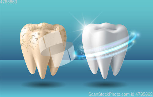 Image of Clean and dirty tooth before and after whitening