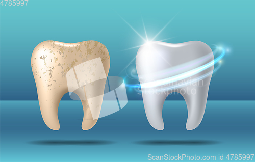 Image of Clean and dirty tooth before and after whitening