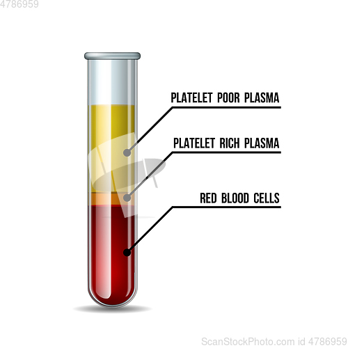 Image of Test tube filled with blood after centrifuge for PRP injection procedures. Platelet-rich plasma laboratory equipment.