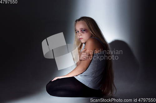 Image of Sad and frightened little girl with bloodshot and bruised eyes sitting scared