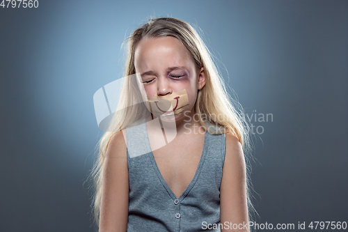 Image of Sad and frightened little girl with bloodshot and bruised eyes, fiction of happiness