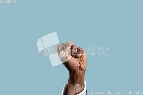 Image of Close up of male hands with vitiligo pigments isolated on blue studio background