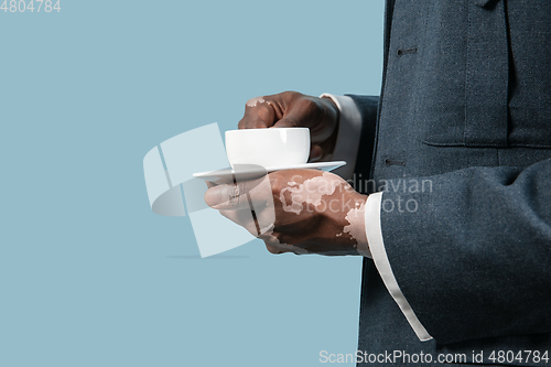 Image of Close up of male hands with vitiligo pigments isolated on blue studio background