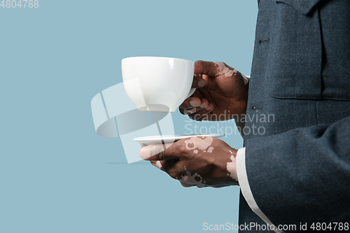 Image of Close up of male hands with vitiligo pigments isolated on blue studio background