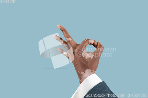 Image of Close up of male hands with vitiligo pigments isolated on blue studio background