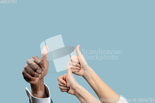 Image of Close up of male and female hands with vitiligo pigments isolated on blue studio background