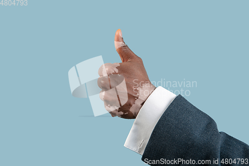 Image of Close up of male hands with vitiligo pigments isolated on blue studio background