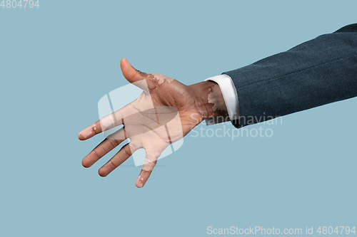 Image of Close up of male hands with vitiligo pigments isolated on blue studio background