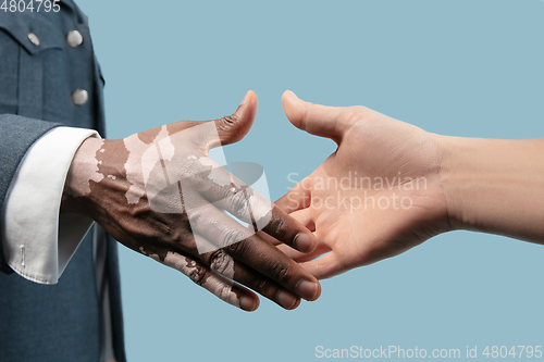 Image of Close up of male hands with vitiligo pigments isolated on blue studio background