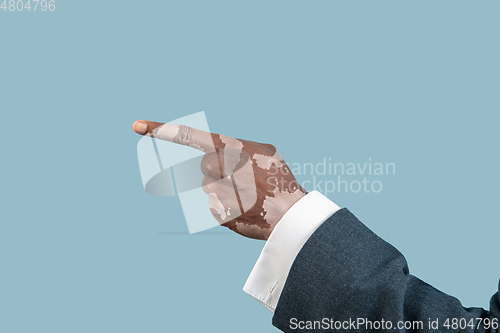 Image of Close up of male hands with vitiligo pigments isolated on blue studio background