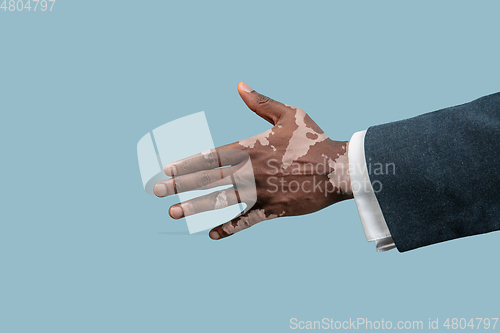 Image of Close up of male hands with vitiligo pigments isolated on blue studio background