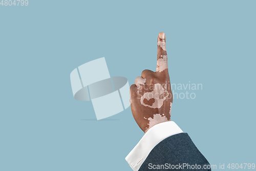 Image of Close up of male hands with vitiligo pigments isolated on blue studio background