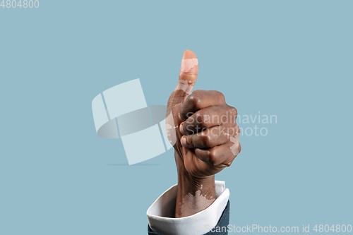 Image of Close up of male hands with vitiligo pigments isolated on blue studio background