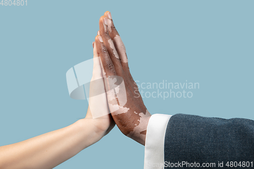 Image of Close up of male hands with vitiligo pigments isolated on blue studio background