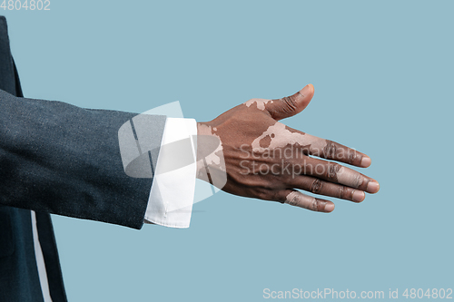 Image of Close up of male hands with vitiligo pigments isolated on blue studio background