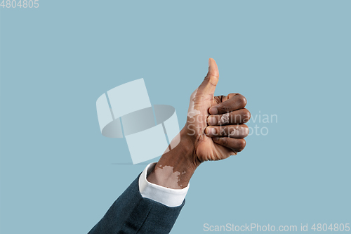 Image of Close up of male hands with vitiligo pigments isolated on blue studio background