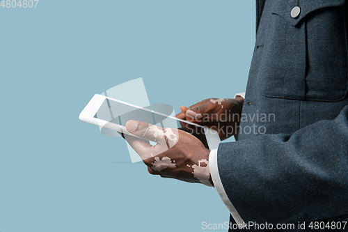 Image of Close up of male hands with vitiligo pigments isolated on blue studio background