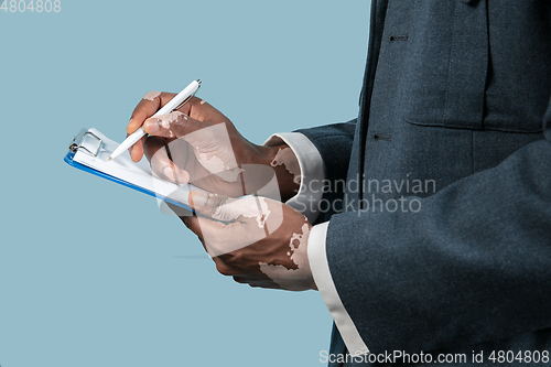 Image of Close up of male hands with vitiligo pigments isolated on blue studio background