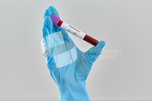 Image of hand holding beaker with coronavirus blood test