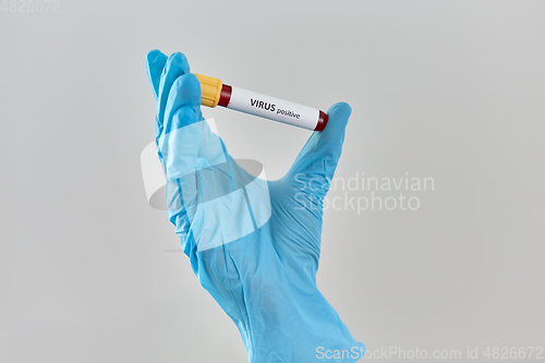 Image of hand holding beaker with positive virus blood test