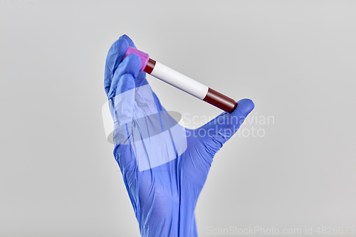 Image of hand in glove holding beaker with blood test