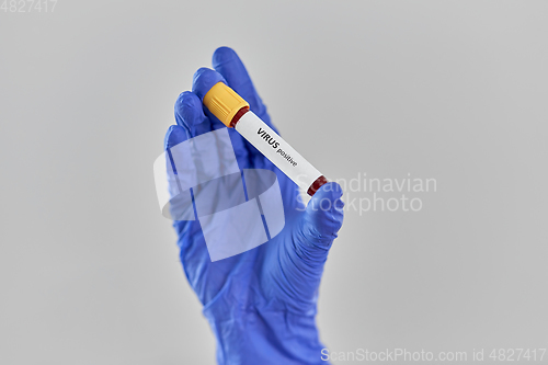 Image of hand holding beaker with positive virus blood test