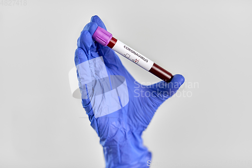 Image of hand holding beaker with coronavirus blood test