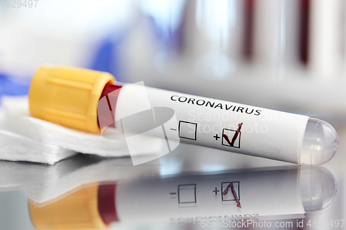 Image of beaker with coronavirus blood test at laboratory