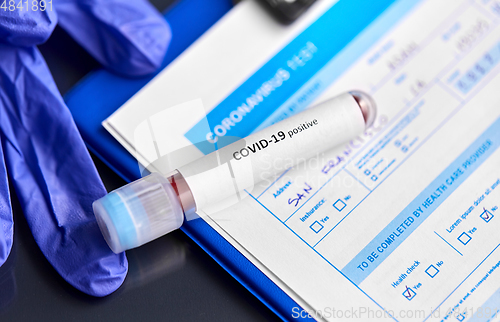 Image of close up of beaker with coronavirus blood test