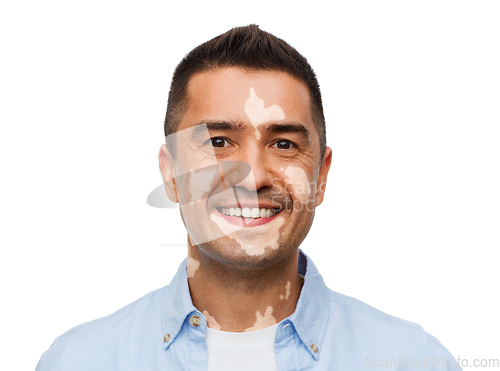 Image of happy smiling man with vitiligo