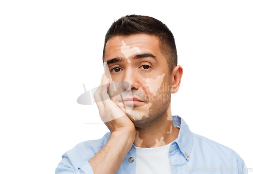 Image of unhappy sad man with vitiligo