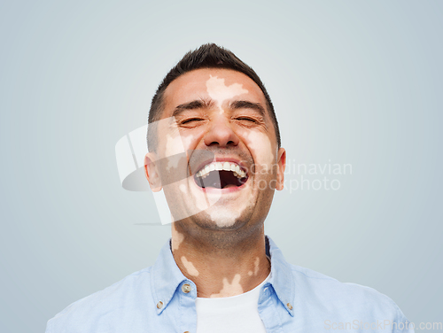 Image of happy laughing man with vitiligo