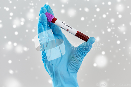 Image of hand holding beaker with coronavirus blood test