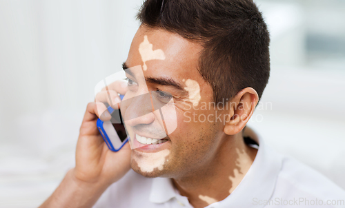 Image of happy man with vitiligo on face calling on phone