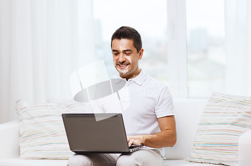 Image of happy man with vitiligo and laptop at home