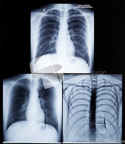 Image of X-Ray Image Of Human Chest