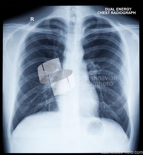 Image of X-Ray Image Of Human Chest