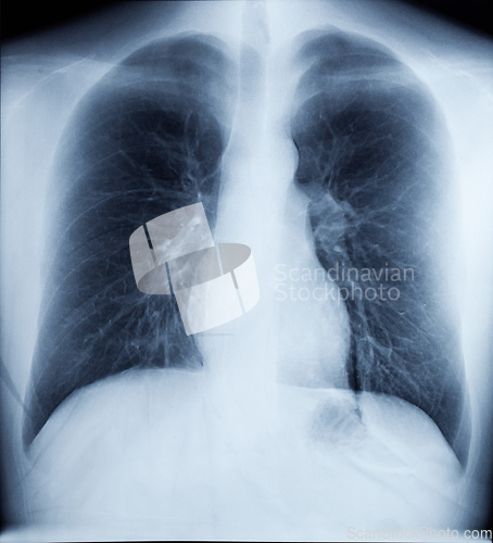 Image of X-Ray Image Of Human Chest