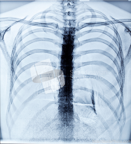 Image of X-Ray Image Of Human Chest