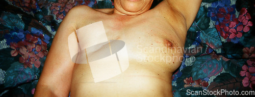 Image of Breast cancer surgery.