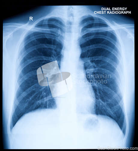 Image of X-Ray Image Of Human Chest