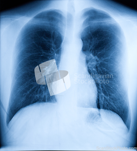 Image of X-Ray Image Of Human Chest