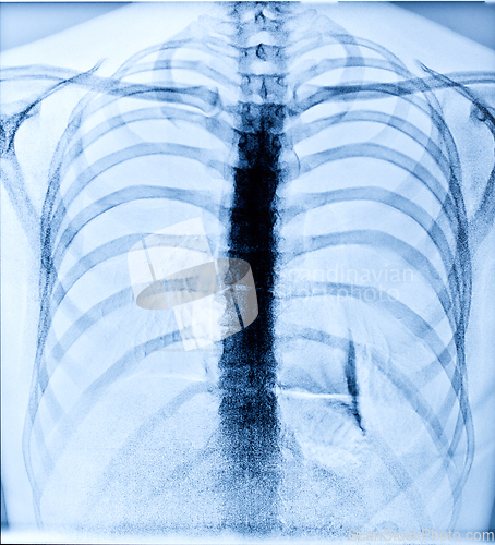 Image of X-Ray Image Of Human Chest