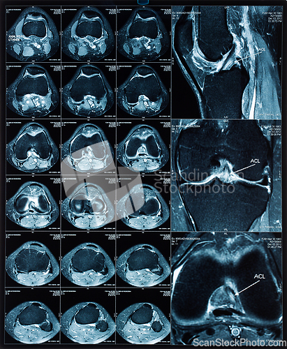 Image of Magnetic resonance tomography (MRT) images of knee