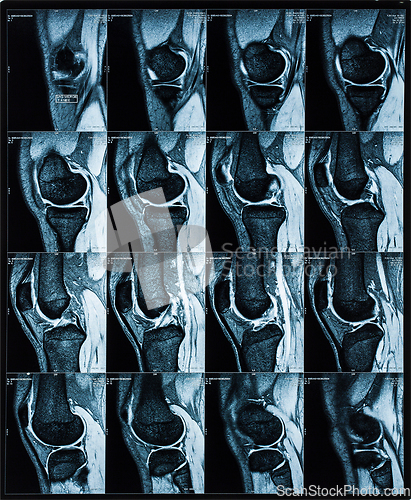 Image of Magnetic resonance tomography (MRT) images of knee