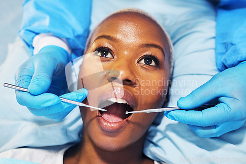 Image of Dental surgeon, woman and tools in mouth at clinic for cavity, teeth whitening and helping hand for pain. Dentist, African patient and top view for tooth extraction, care and check for healthy smile