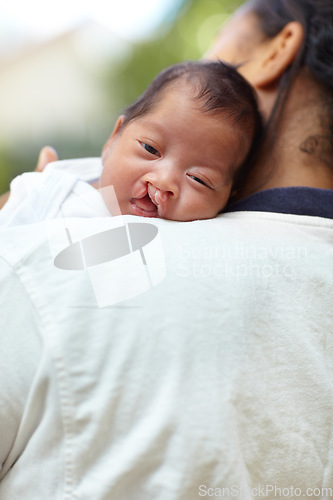 Image of Portrait, cleft palate and baby with health, care and hug with mother, relax and bonding together. Face, mama and happy infant embrace, medical condition and family with newborn, mouth and resting