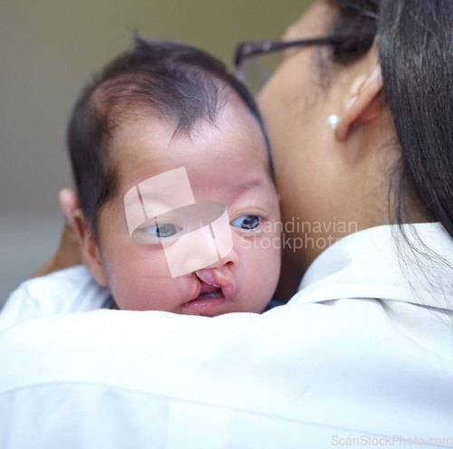 Image of Medical, cleft lip and a pediatrician with a baby in the hospital for insurance, care or treatment. Healthcare, children and a doctor woman holding a newborn with a disability in a health clinic